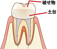 根管治療とは？