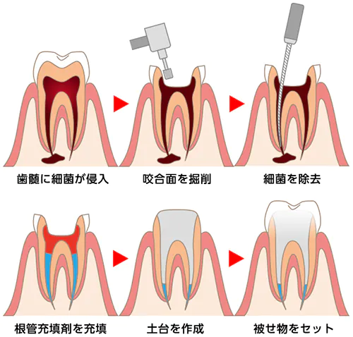 根管治療の流れ